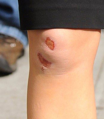0430 jennifer garner scraped knee bd